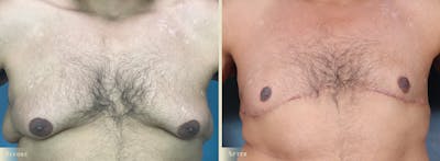 Male Breast Reduction (Gynecomastia) Before & After Gallery - Patient 486411 - Image 1