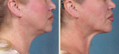 Neck Liposuction Before & After Gallery - Patient 526282 - Image 1