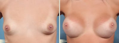 Breast Augmentation Before & After Gallery - Patient 353518 - Image 1