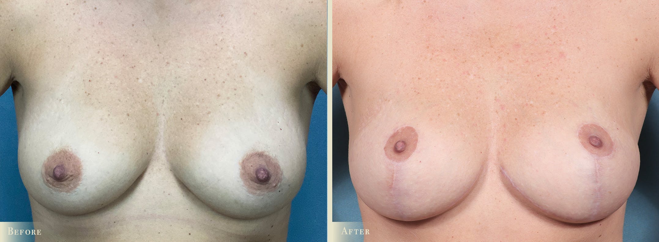 Breast Augmentation and Lift Before & After Gallery - Patient 243149 - Image 1