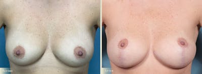 Breast Augmentation and Lift Before & After Gallery - Patient 243149 - Image 1
