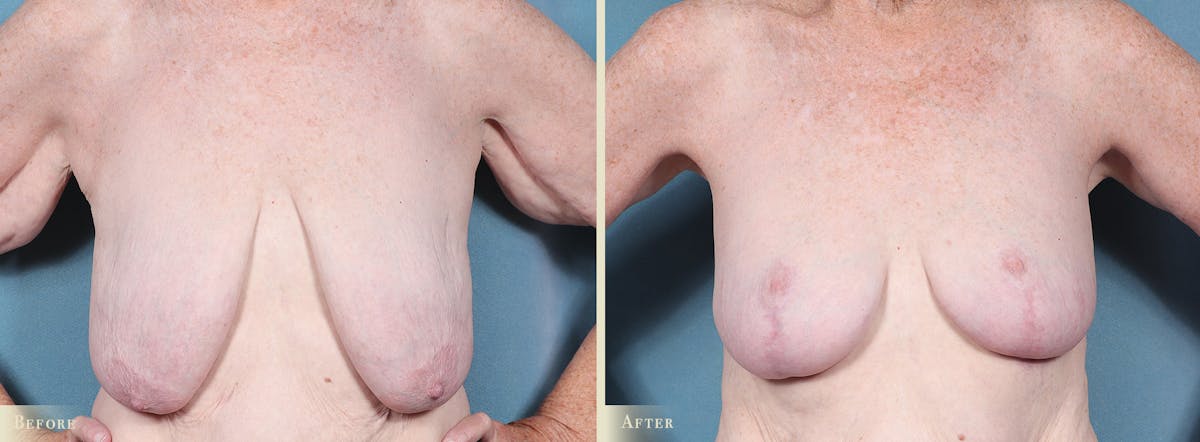 Breast Lift Before & After Gallery - Patient 364375 - Image 1