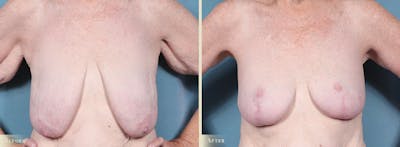 Breast Lift Before & After Gallery - Patient 364375 - Image 1