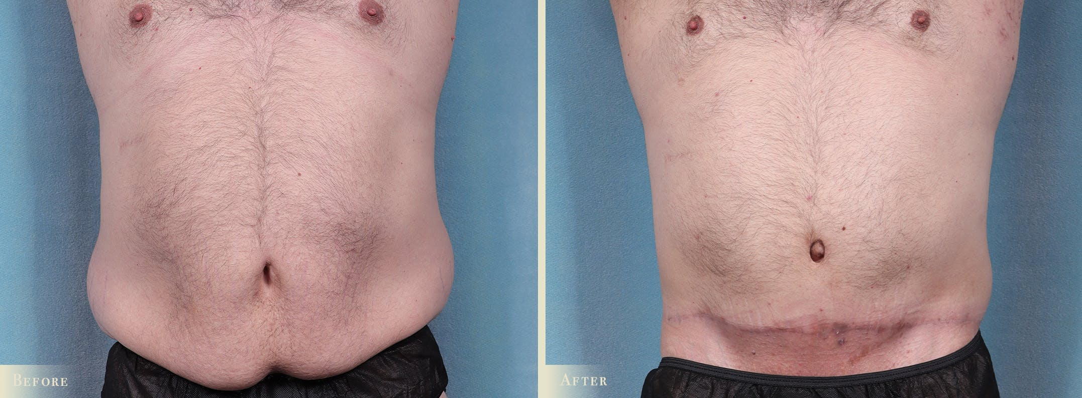 Male Tummy Tuck Before & After Gallery - Patient 159841 - Image 1