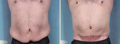 Male Tummy Tuck Before & After Gallery - Patient 159841 - Image 1