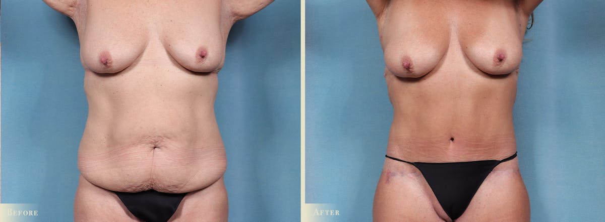 Weight Loss Body Contouring Combination Procedures Before & After Gallery - Patient 300614 - Image 1