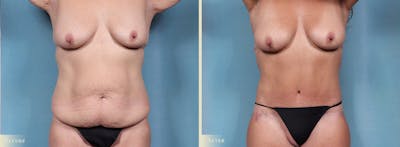 Weight Loss Body Contouring Combination Procedures Before & After Gallery - Patient 300614 - Image 1
