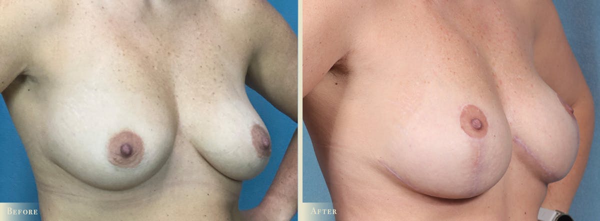 Breast Augmentation and Lift  Before & After Gallery - Patient 243149 - Image 2