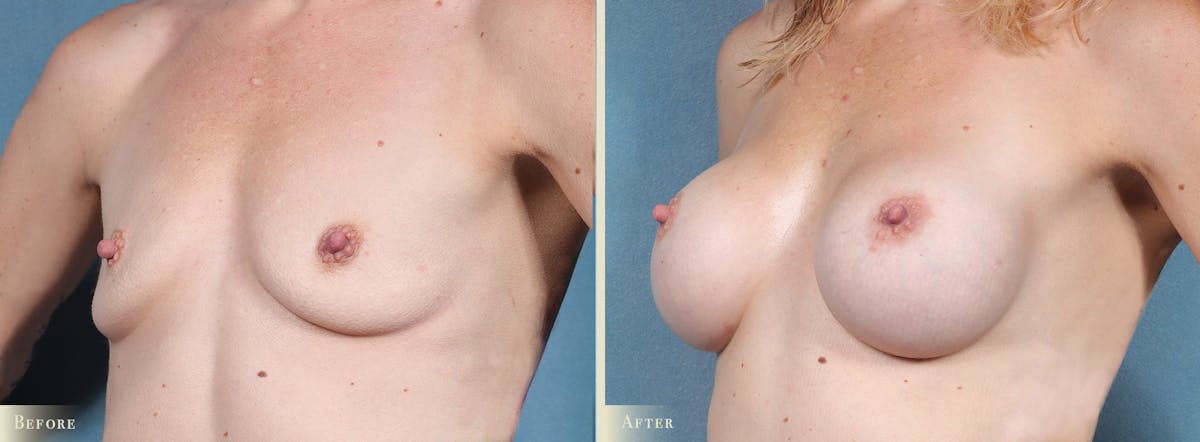 Breast Augmentation Before & After Gallery - Patient 151199 - Image 2