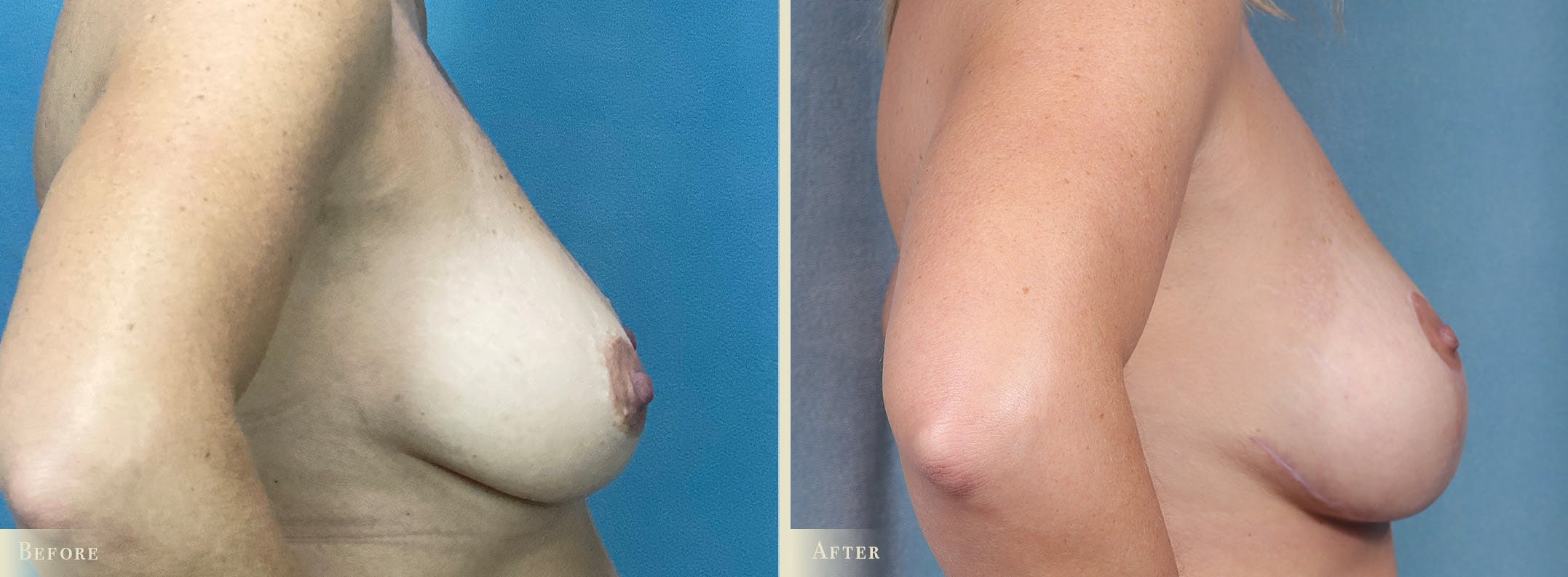 Breast Augmentation and Lift Before & After Gallery - Patient 243149 - Image 3