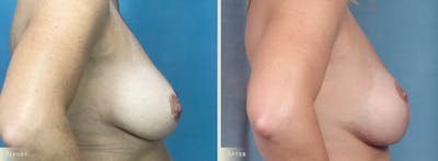 Breast Augmentation and Lift Before & After Gallery - Patient 243149 - Image 3