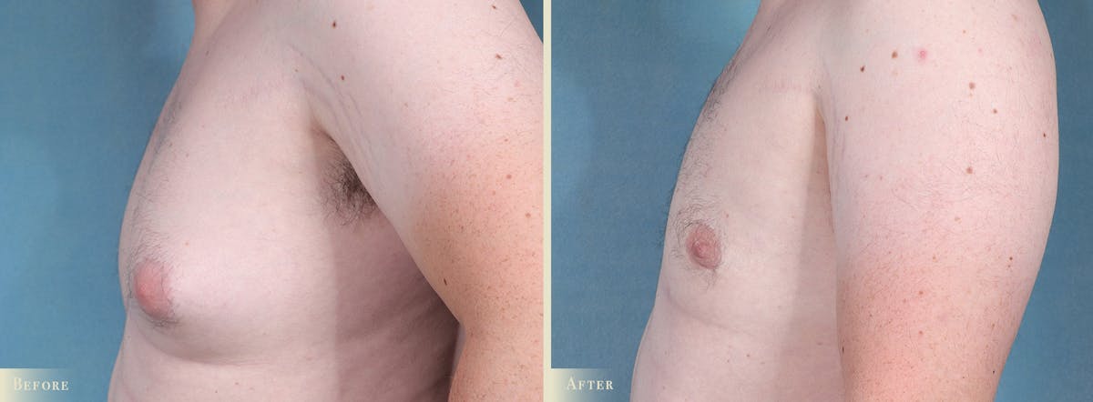 Male Breast Reduction (Gynecomastia) Before & After Gallery - Patient 141689 - Image 3