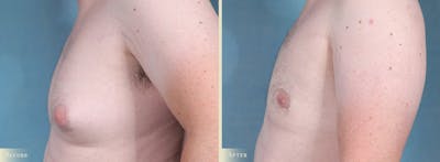 Male Breast Reduction (Gynecomastia) Before & After Gallery - Patient 141689 - Image 3