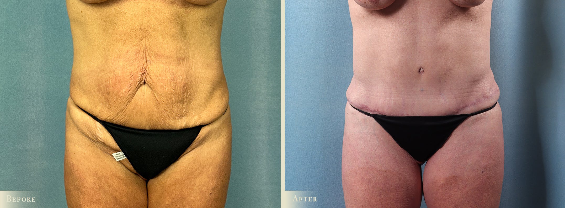 Brazilian Butt Lift Before & After Gallery - Patient 209090 - Image 3