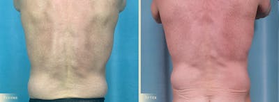 Tummy Tuck Before & After Gallery - Patient 423154 - Image 3