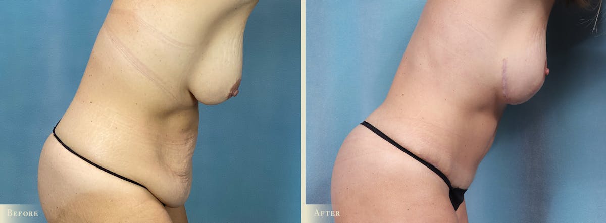 Tummy Tuck Before & After Gallery - Patient 505872 - Image 3