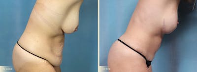 Tummy Tuck Before & After Gallery - Patient 505872 - Image 3