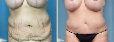 Tummy Tuck Before & After Gallery - Patient 602610 - Image 1