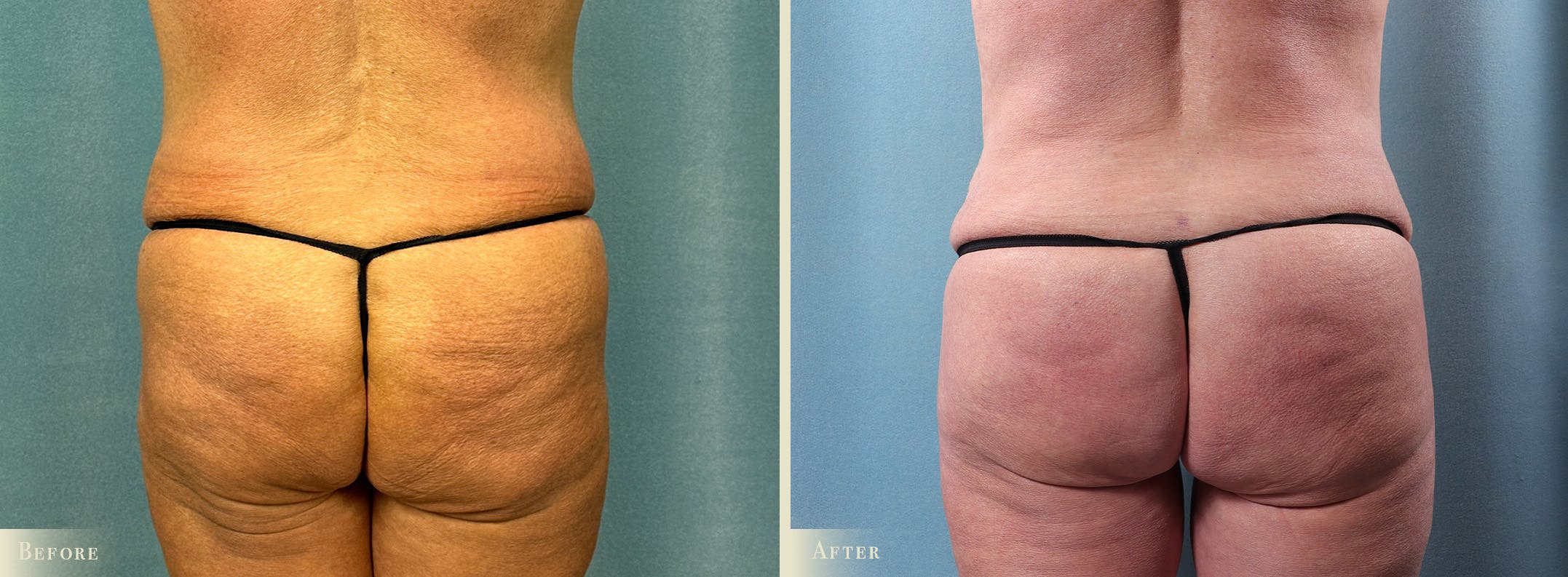 Brazilian Butt Lift Before & After Gallery - Patient 209090 - Image 1