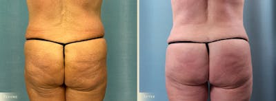 Brazilian Butt Lift Before & After Gallery - Patient 209090 - Image 1