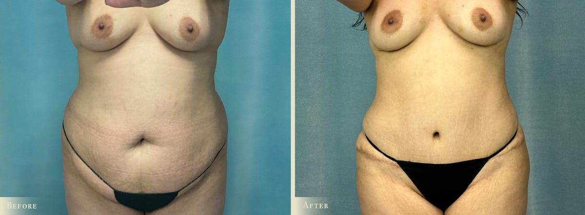 Tummy Tuck Before & After Gallery - Patient 141256 - Image 1