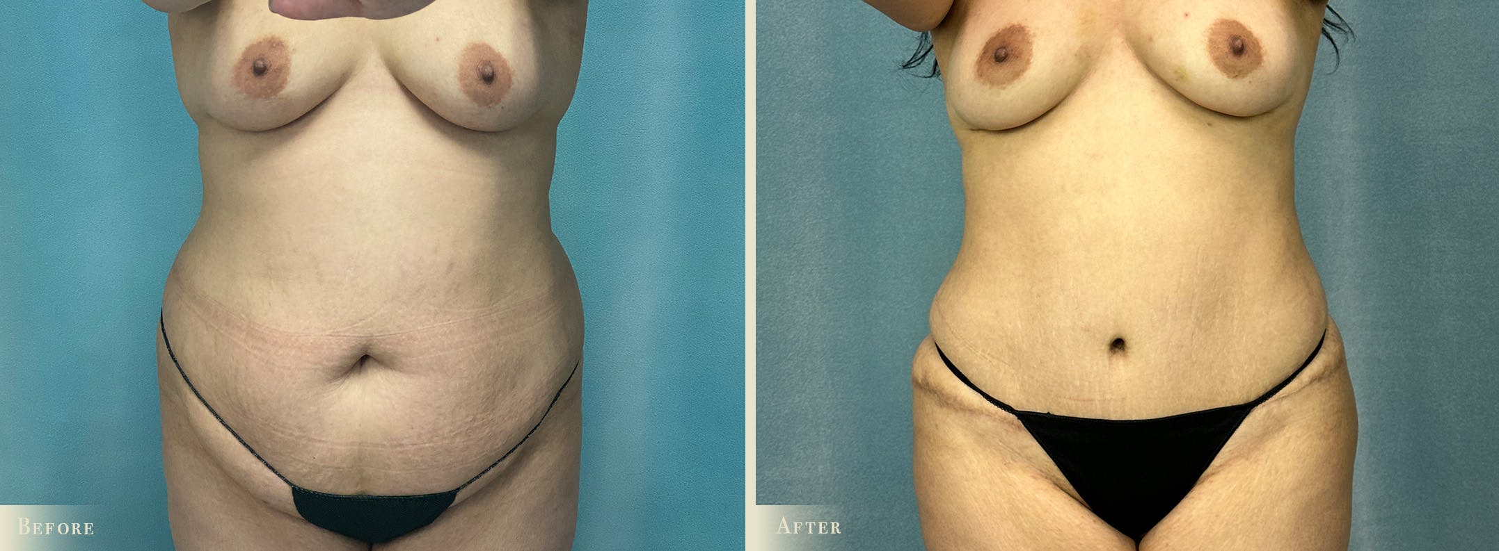 Tummy Tuck Before & After Gallery - Patient 141256 - Image 1