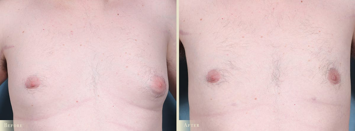 Male Breast Reduction (Gynecomastia) Before & After Gallery - Patient 141689 - Image 1