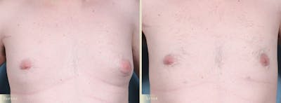 Male Breast Reduction (Gynecomastia) Before & After Gallery - Patient 141689 - Image 1