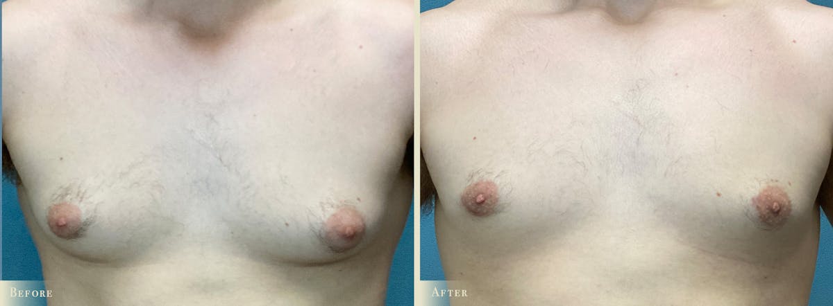 Male Breast Reduction (Gynecomastia) Before & After Gallery - Patient 184612 - Image 1