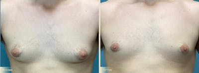 Male Breast Reduction (Gynecomastia) Before & After Gallery - Patient 184612 - Image 1