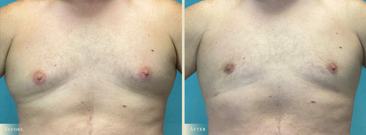 Male Breast Reduction (Gynecomastia) Before & After Gallery - Patient 362493 - Image 1
