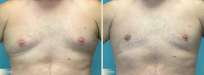 Male Breast Reduction (Gynecomastia) Before & After Gallery - Patient 362493 - Image 1