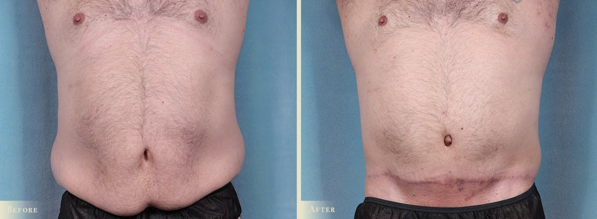 Tummy Tuck Before & After Gallery - Patient 374256 - Image 1
