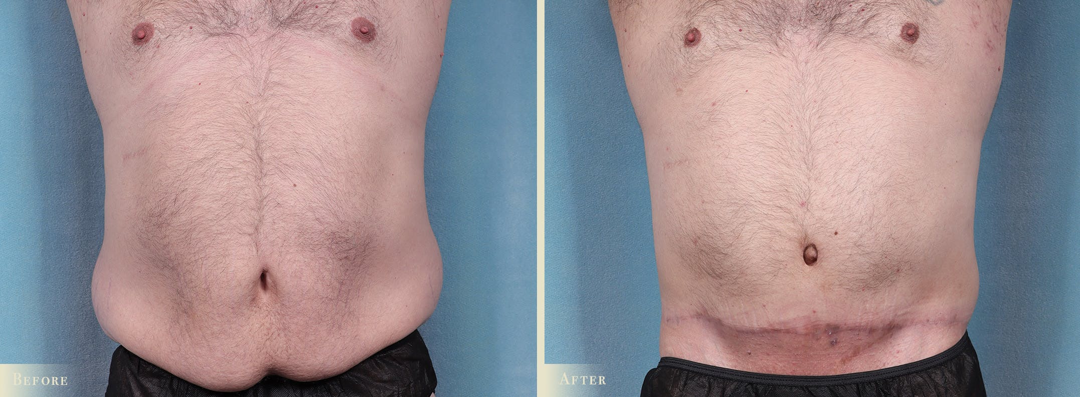 Tummy Tuck Before & After Gallery - Patient 374256 - Image 1