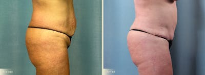 Brazilian Butt Lift Before & After Gallery - Patient 209090 - Image 2