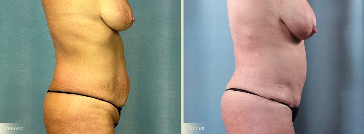 Tummy Tuck Before & After Gallery - Patient 417453 - Image 2