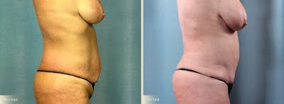 Tummy Tuck Before & After Gallery - Patient 417453 - Image 2