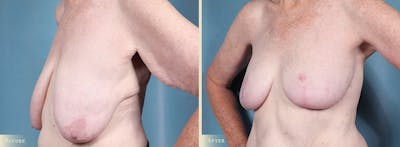 Breast Lift Before & After Gallery - Patient 364375 - Image 2