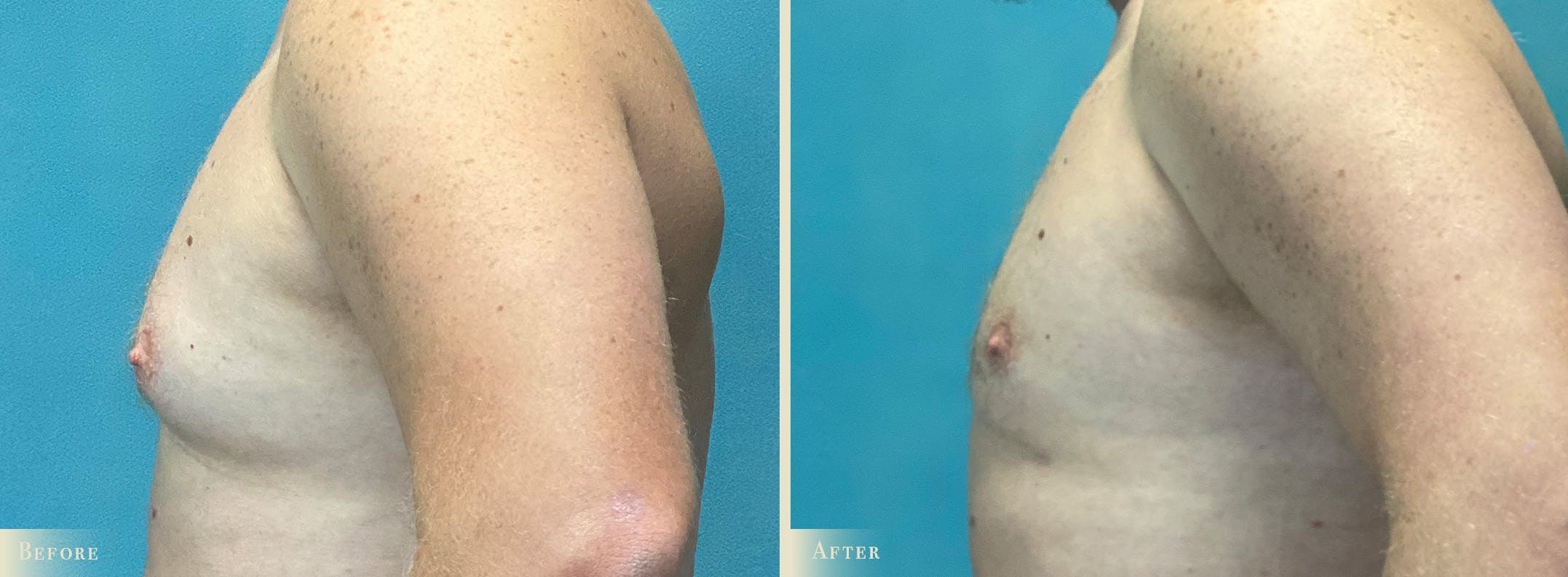 Male Breast Reduction (Gynecomastia) Before & After Gallery - Patient 362493 - Image 3