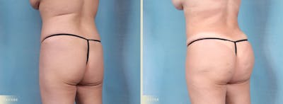 Brazilian Butt Lift Before & After Gallery - Patient 353945 - Image 2