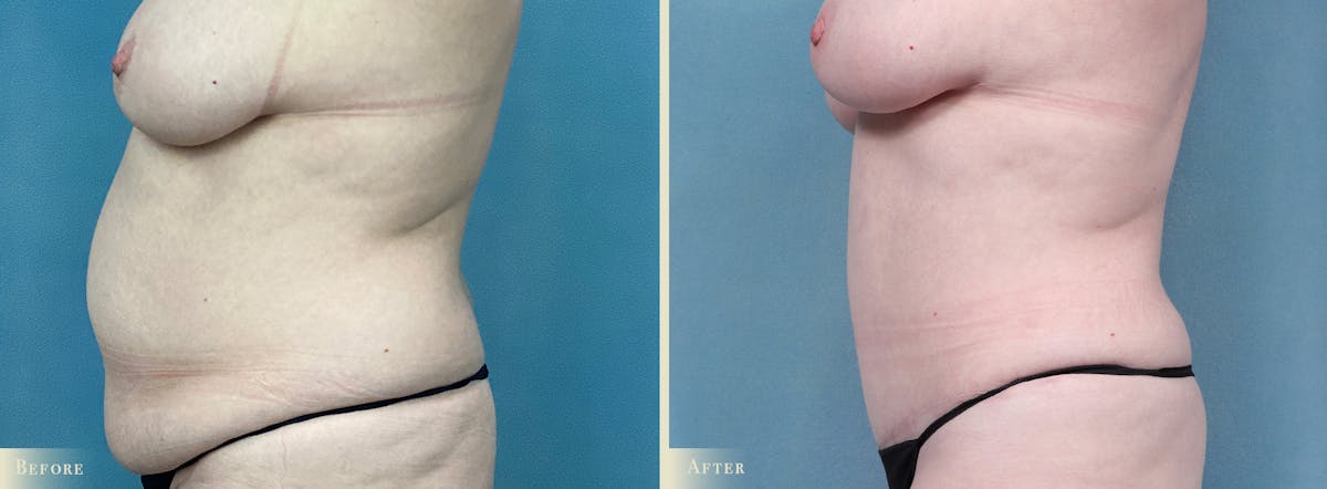 Tummy Tuck Before & After Gallery - Patient 205763 - Image 3