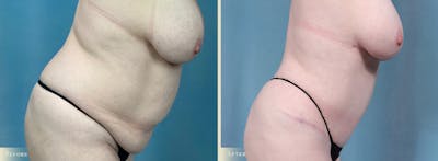 Tummy Tuck Before & After Gallery - Patient 205763 - Image 4