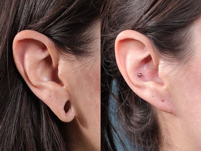 Earlobe Repair Before & After Gallery - Patient 244986 - Image 2
