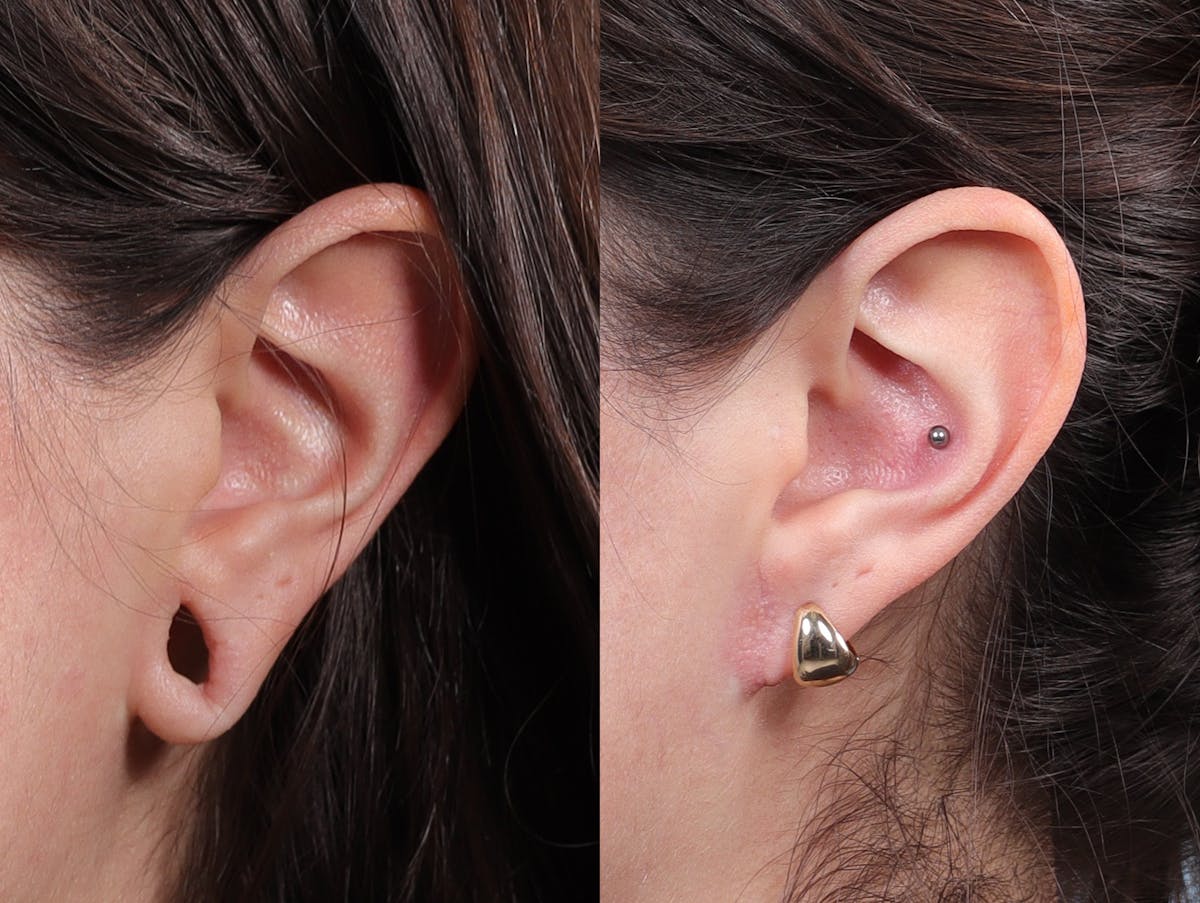 Earlobe Repair Before & After Gallery - Patient 244986 - Image 4