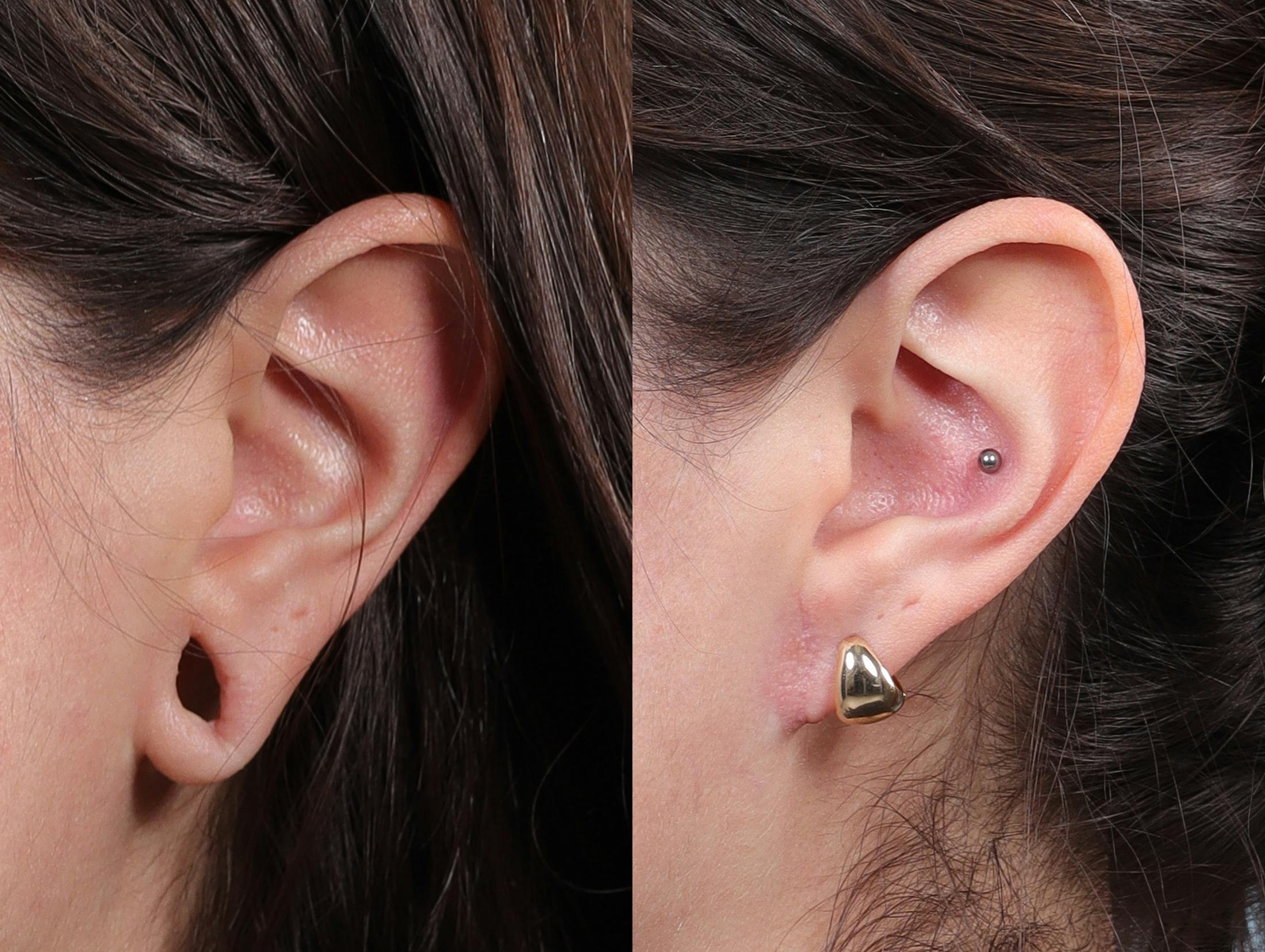 Earlobe Repair Before & After Gallery - Patient 244986 - Image 4