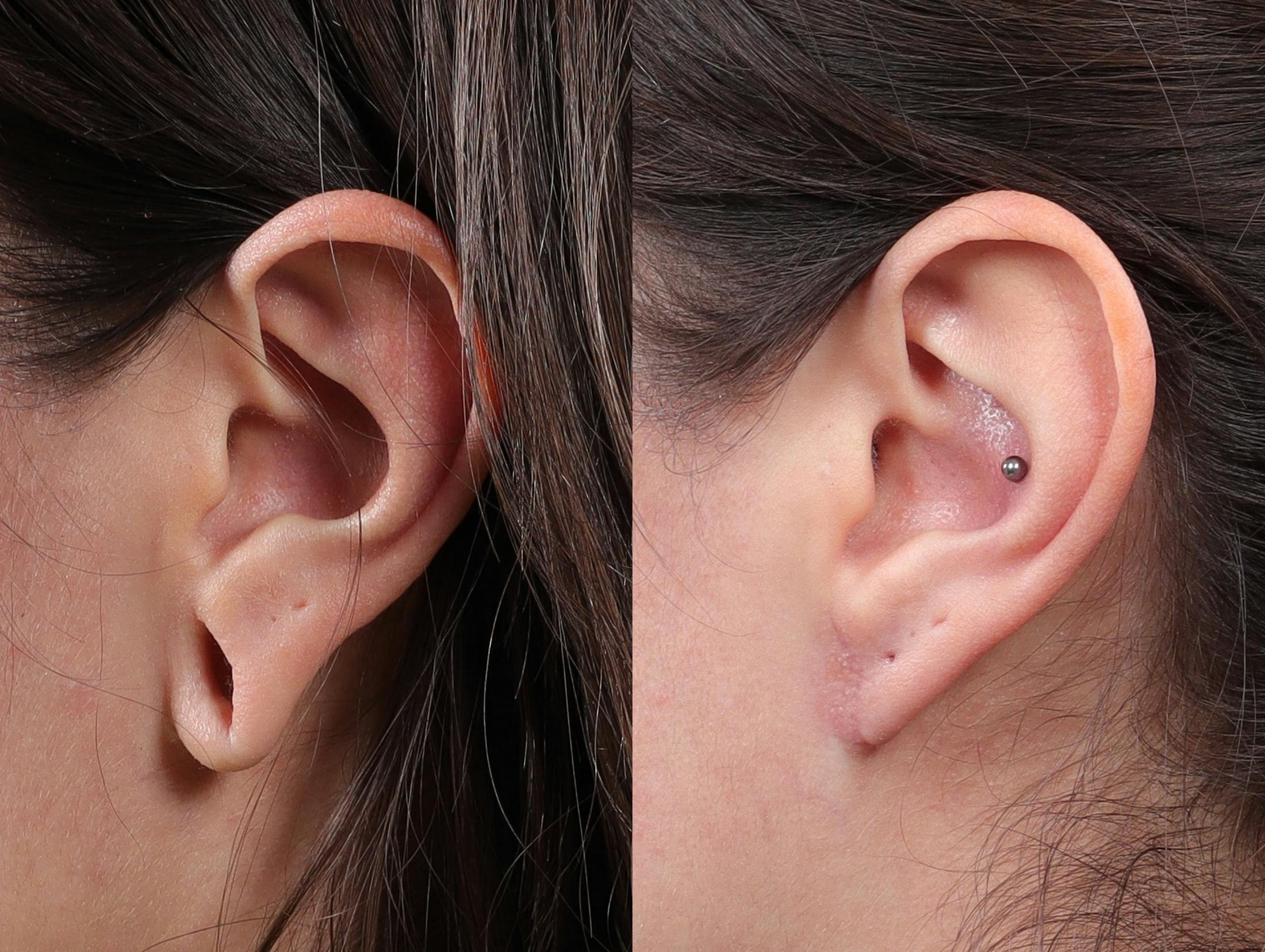 Earlobe Repair Before & After Gallery - Patient 244986 - Image 3