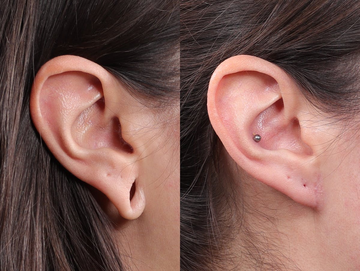 Earlobe Repair Before & After Gallery - Patient 244986 - Image 1