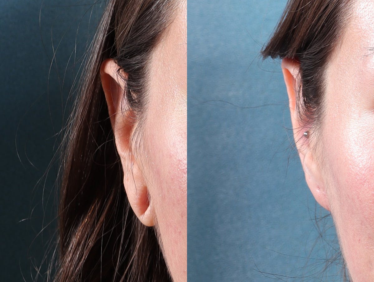 Earlobe Repair Before & After Gallery - Patient 244986 - Image 5