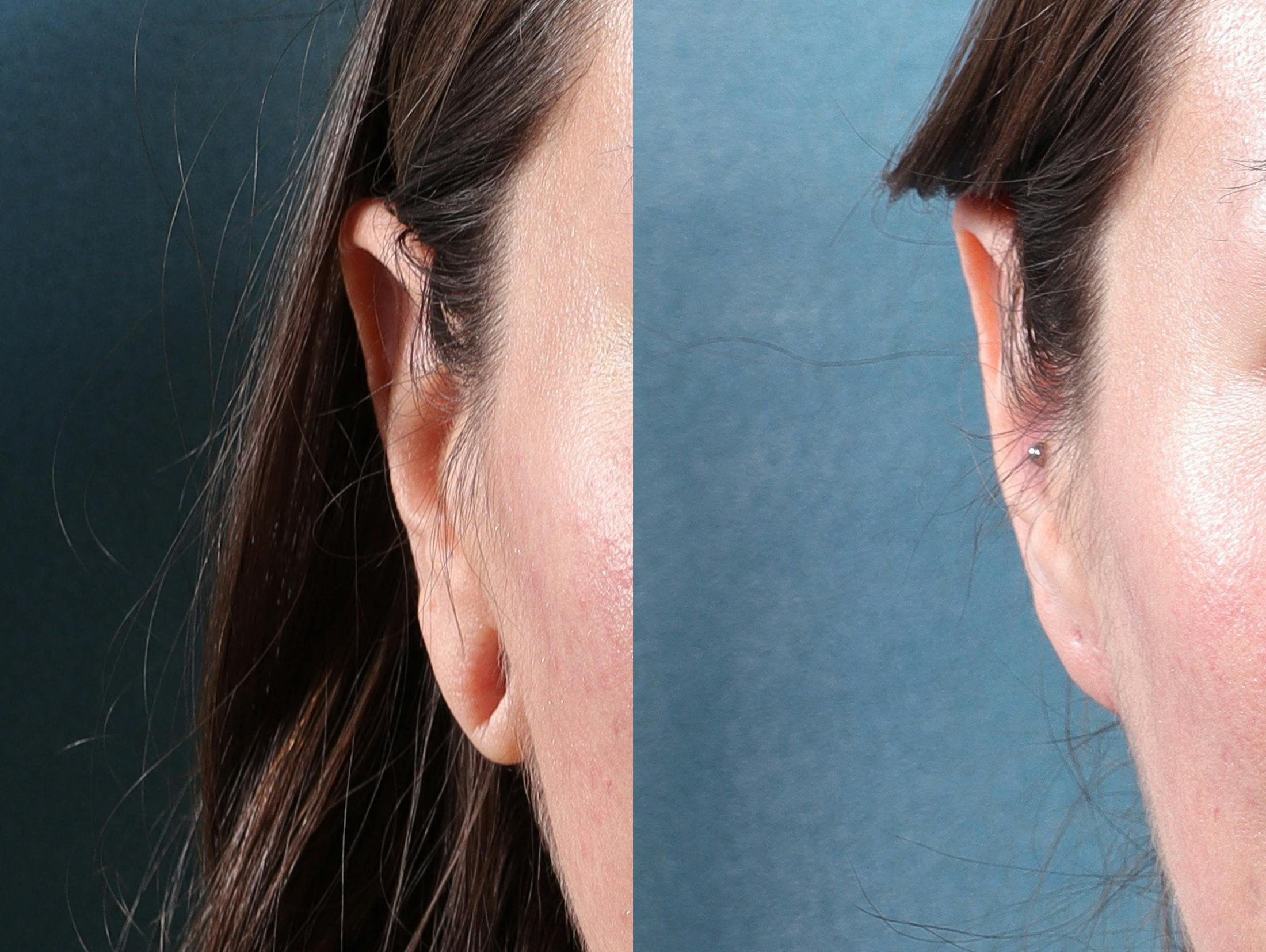 Earlobe Repair Before & After Gallery - Patient 244986 - Image 5