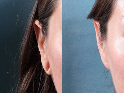 Earlobe Repair Before & After Gallery - Patient 244986 - Image 5